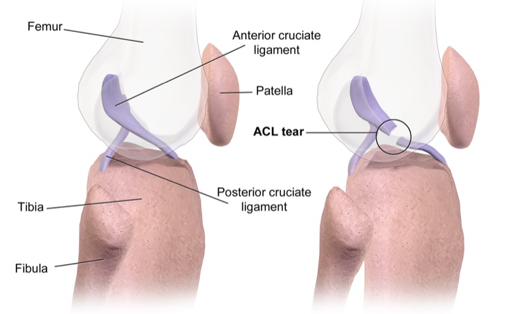 Knee joint showing a torn anterior cruciate ligament