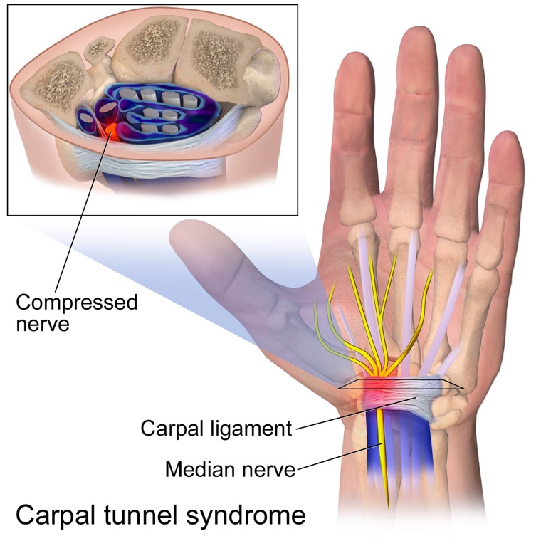 Cross-section of the wrist showing the median nerve compressed in the carpal tunnel