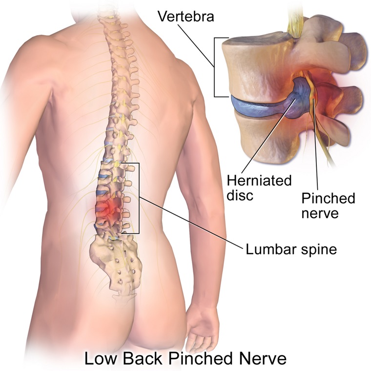 Lumbar spine showing a herniated disc pressing on a nerve root