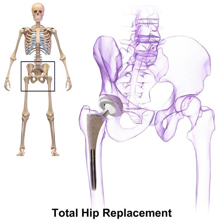 Total hip replacement implant: stem, ball, and socket components in place