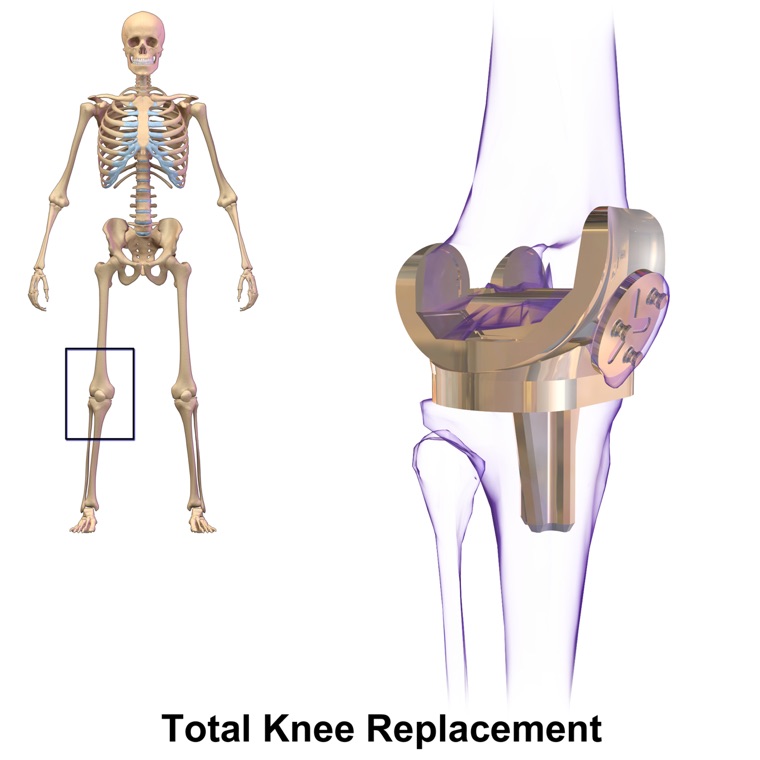 Total knee replacement implant: metal femoral component and tibial plate on a translucent knee