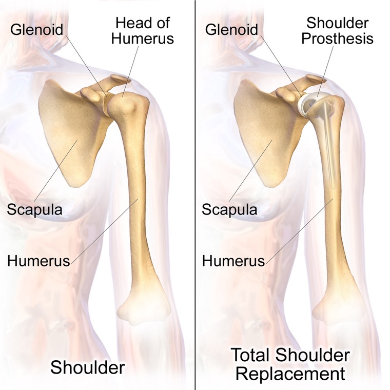 Shoulder arthroplasty implant in place